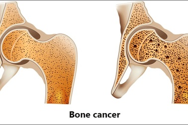 Nguyên nhân gây ung thư xương