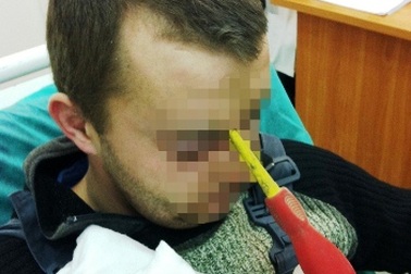 Soi gương mới phát hiện thấy tua-vít đâm xuyên trán