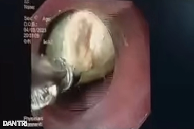 Sản phụ suýt mất mạng vì nuốt mật lợn