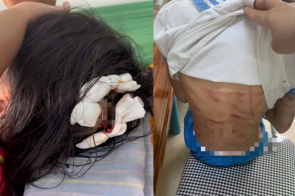 Công an vào cuộc vụ bé gái lớp 5 nghi bị cha dượng bạo hành - 1 Công an vào cuộc vụ bé gái lớp 5 nghi bị cha dượng bạo hành - 1