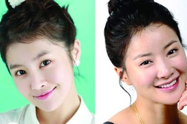 Phẫu thuật cười hở lợi kết hợp chỉnh răng hô