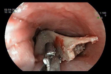 Bệnh nhân hóc xương vịt, bác sĩ “phán” bệnh tim