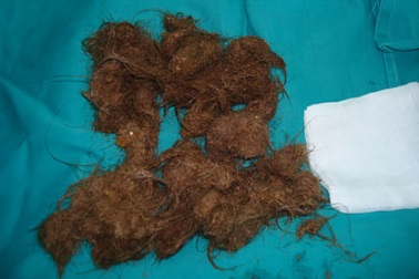 Búi tóc nặng 0,5kg trong dạ dày một bé gái