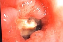 Hy hữu bệnh nhân mắc xương cá 5 năm không biết