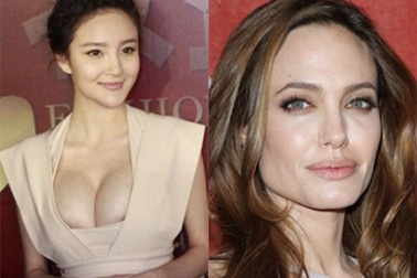 “Sao” mê phẫu thuật độn cằm