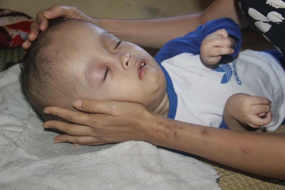 Xót xa cảnh vợ mù lòa ôm con bị não úng thủy nằm liệt giường suốt nhiều năm - 5 Xót xa cảnh vợ mù lòa ôm con bị não úng thủy nằm liệt giường suốt nhiều năm - 5