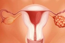 Phương pháp điều trị nào tối ưu với ung thư buồng trứng?