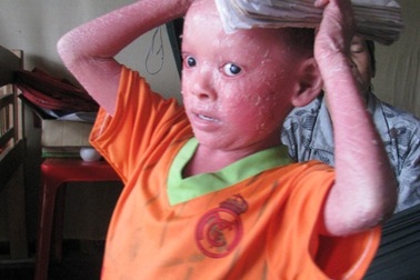 Thăm lại cháu bé “vẩy cá” Nguyễn Hoàng Long