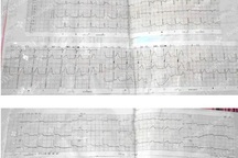 Virus siêu nhỏ nhưng gây viêm cơ tim cấp nguy hiểm