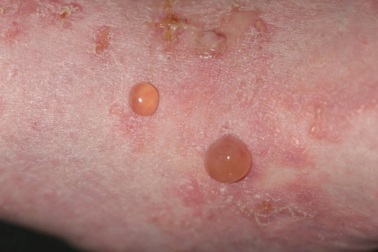 Căn bệnh hiếm nguy hiểm khiến da nổi bọng nước, dễ chẩn đoán nhầm