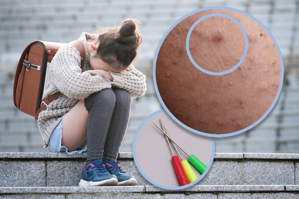 Chinees meisje wordt ervan verdacht honderden keren in haar been te zijn gestoken door een klasgenoot met een naai-priem - 1 Bé gái Trung Quốc nghi bị bạn học dùng dùi khâu đâm vào chân cả trăm nhát - 1