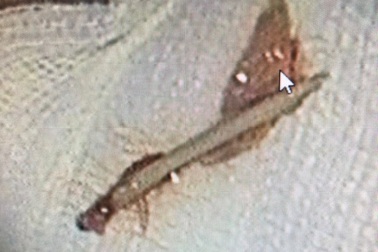 Người đàn ông hóc xương gà dài 6cm mắc sâu trong thành thực quản