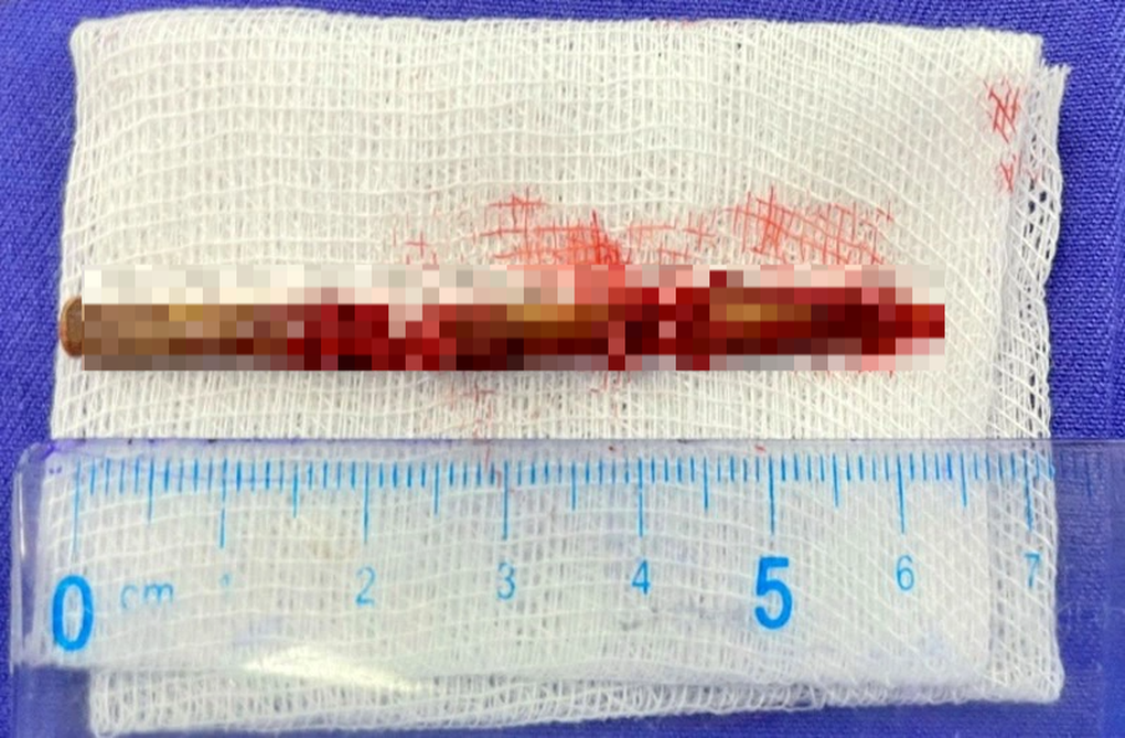 Nín thở ca mổ gắp đoạn đũa 7cm nằm trong đầu người đàn ông - 2
