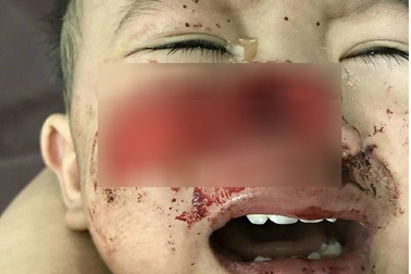 Liên tiếp hai bé trai bị chó nhà cắn nát mặt, rách cổ