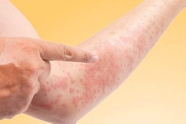  Tại sao mề đay hay tái phát?