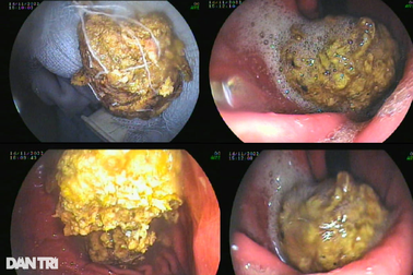 Ăn quả hồng giòn, người đàn ông suýt mất mạng?