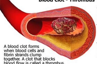 7 nguyên tắc sống giúp giảm máu đóng cục