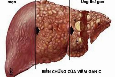Việt Nam đạt được thoả thuận về thuốc chữa viêm gan C giá rẻ