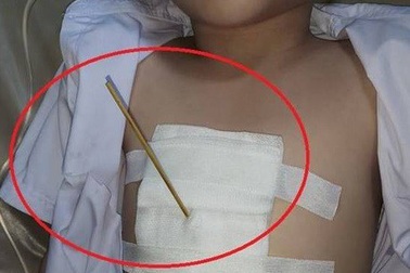 Vừa ăn cá viên chiên vừa chơi, bé 7 tuổi bị que xiên đâm thấu ngực