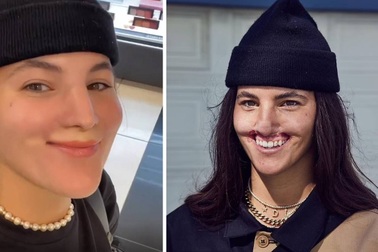 Nụ cười đầy nghị lực của người mẫu bị chó pit bull cắn rách môi