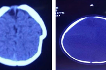 Bé gái 8 tháng tuổi bị lún sọ não vì ngã xe tập đi