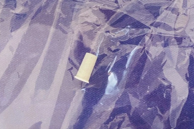 Nghe tiếng còi phát ra từ cổ họng trẻ, bác sĩ lấy ra dị vật bất ngờ