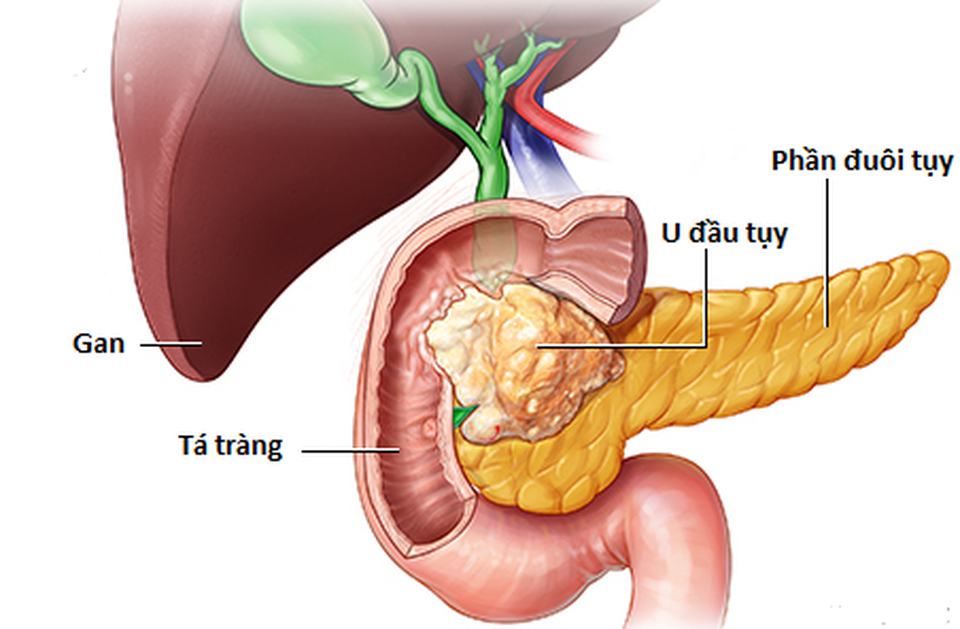 Những triệu chứng của ung thư tụy - 1 Những triệu chứng của ung thư tụy - 1
