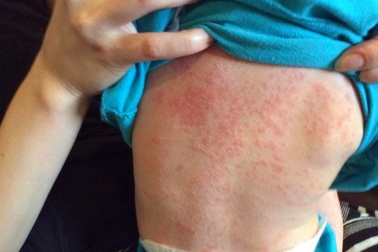 Bệnh viện Nhi Trung ương: 85% trẻ mắc bệnh sởi đều chưa được tiêm phòng