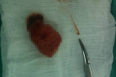 Mổ ruột thừa phát hiện xương cá đâm thủng ruột