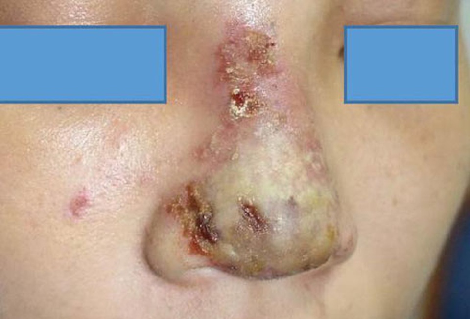 Má đỏ rực như hai quả cà chua sau khi tiêm filler giảm nếp nhăn tại spa - 2