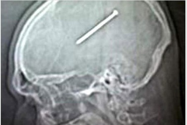 5 bức ảnh X-quang khó tin nhất về các vết thương do dị vật