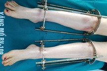 Bác sĩ kể ca kéo dài chân của cô gái Hà Nội cao 1,38m