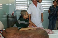 Người mang khối u khổng lồ sắp được “giải thoát”