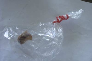 Nhiễm trùng khí quản vì hóc dị vật