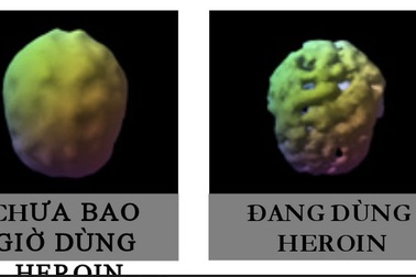 Vì sao nghiện ma tuý là… bệnh mãn tính?