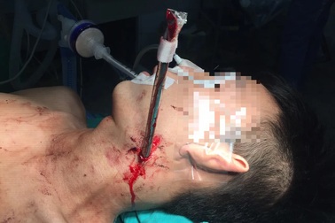 Thanh sắt giàn treo cắm ngập cổ nam công nhân