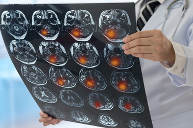 Phương pháp mới giúp ngăn chặn sự lây lan của tế bào ung thư não