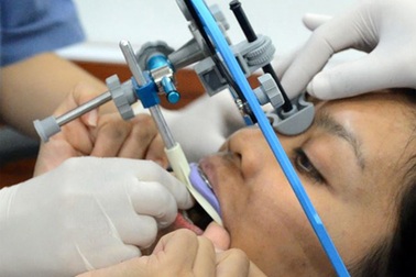 Phẫu thuật hàm hô móm (vẩu)