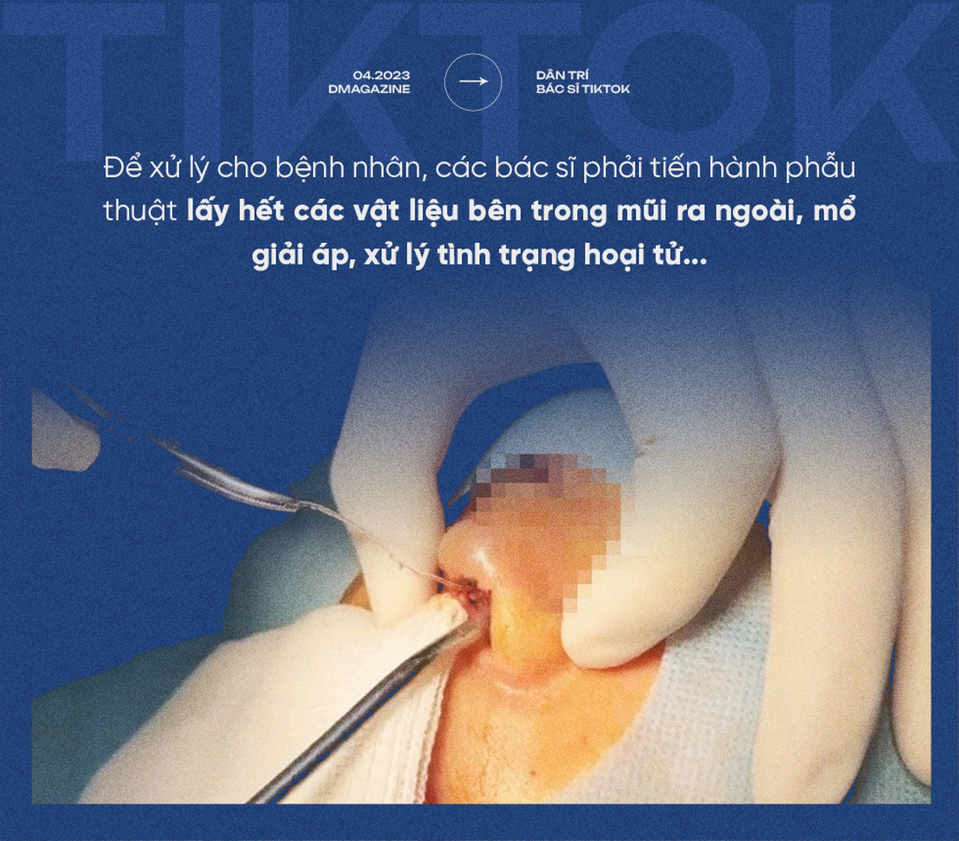 Nát mũi, hỏng mặt, biến chứng thai kỳ vì bác sĩ Tiktok - 3 Nát mũi, hỏng mặt, biến chứng thai kỳ vì bác sĩ Tiktok - 3