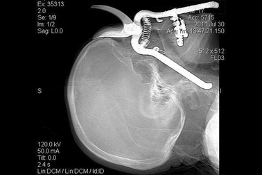 Khó tin những tai nạn dị vật đâm xuyên não vẫn sống sót