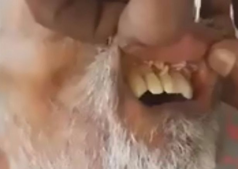 Giòi nhung nhúc trong miệng bệnh nhân đột quỵ - 1 Giòi nhung nhúc trong miệng bệnh nhân đột quỵ - 1
