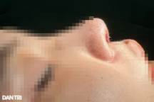 Xem TikTok vào spa làm đẹp 63 triệu đồng, mũi cô gái khâu 3 lần vẫn hỏng