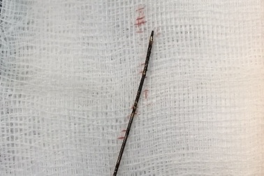 Cây kim khâu gỉ sét nằm trong lồng ngực bé gái 3 tuổi suốt hai năm