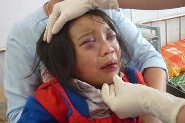 3 năm tù cho hai vợ chồng "ngược đãi" con nuôi.