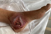 Gần 2 triệu người mắc bệnh đái tháo đường chưa được chẩn đoán, điều trị