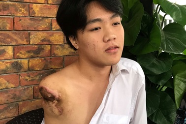 Nam sinh bị máy tiện quấn đứt cánh tay, gia đình bức xúc đòi hỗ trợ!