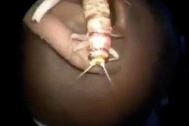 Bệnh nhân sợ hãi khi phát hiện ra con dế dài gần 8cm trong tai