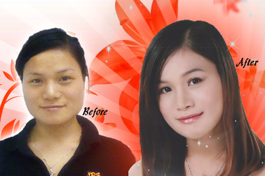 Phẫu thuật thay đổi hoàn toàn khuôn mặt