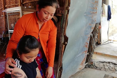 Cô gái bị bệnh rối loạn sắc tố da ở Bạc Liêu.