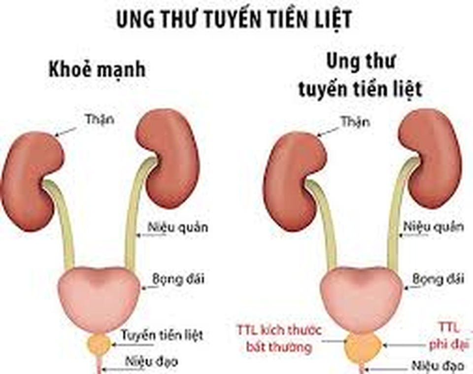 Ngăn ngừa ung thư tuyến tiền liệt - 1 Ngăn ngừa ung thư tuyến tiền liệt - 1